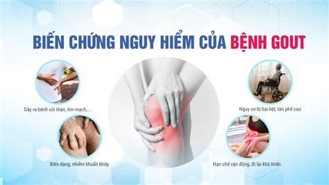 Nhận Biết Sớm Bệnh Gout để Có Cách điều Trị Hiệu Quả Và An Toàn Hệ