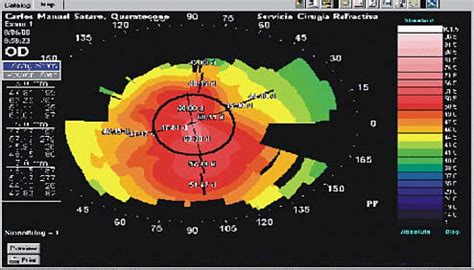 Aplicaciones de la topografía corneal