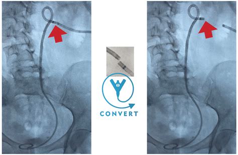 Resolve Convertx Nephroureteral Biliary Stent System Merit Medical