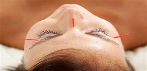 Acupuncture Curbs Hot Flashes In Breast Cancer Survivors