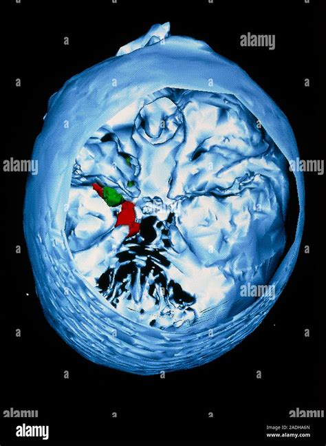 Brain cyst. Coloured three-dimensional magnetic resonance imaging (MRI) scan of a brain cyst as ...