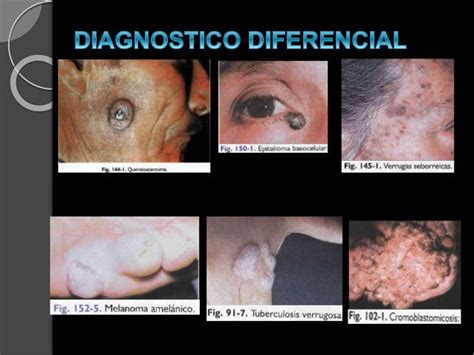 RevisiÓn Del Carcinoma Epidermoide Y Epiteloma Metatipico