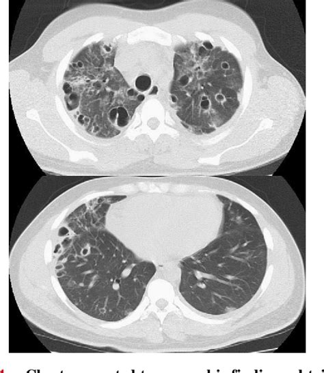 Figure 4 From Necrotizing Pneumonia Due To Femoral Osteomyelitis Caused By Community Acquired