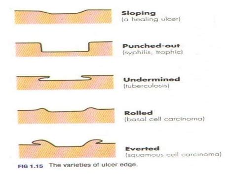 Types Of Wound Ulcers
