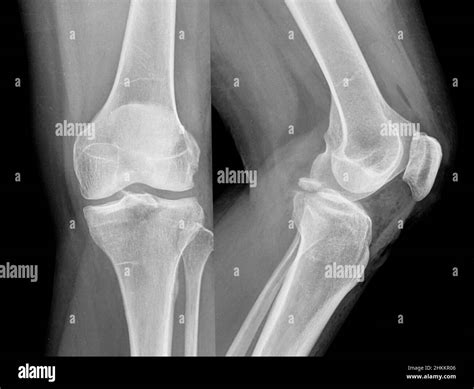 Posterior Cruciate Ligament Avulsion Fracture X Ray Stock Photo Alamy