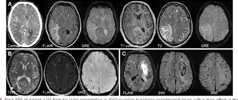 Figure From Inflammatory Cerebral Amyloid Angiopathy A Broad