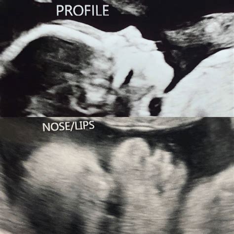 Weeks Pregnant Ultrasound Face