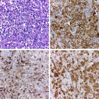 Histopathological And Immunohistochemical Features Of Alkpositive