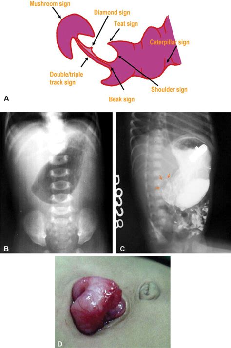 Hypertrophic pyloric stenosis. ( ) A diagrammatic representation of the ...