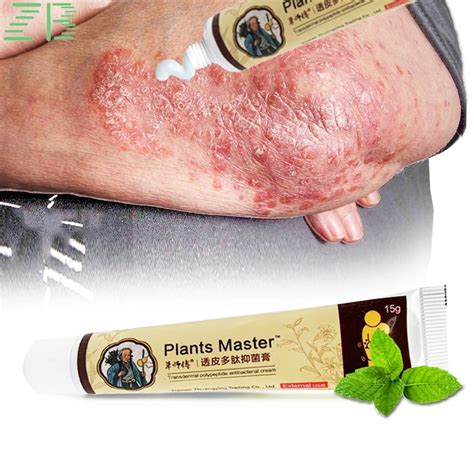 Zb 15g Psoriasis Cream Treatment Dermatitis Eczema Skin Care Medical