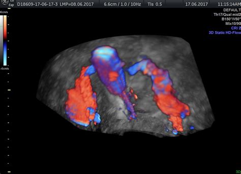 3d Hd Flow Color Hyfosy Highlighting The Contour Of The Endometrial