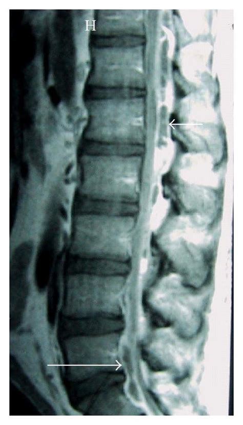 Preoperative T Weighted Mri Scans With Contrast Of Lumbar Spine In A