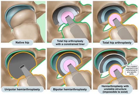 Jcm Free Full Text Deviation Of Latitude Cut A Simple Sign To Differentiate Total Hip