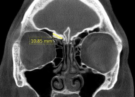 Exploring The Role Of Dental CBCT In ENT A Revolutionary Tool For