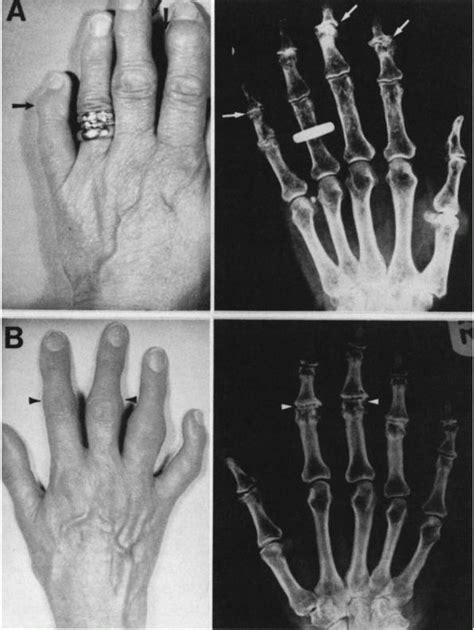 Subtrochanteric Fractures Teachme Orthopedics