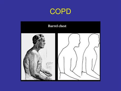 Ppt Management Of Severe Asthma And Copd Powerpoint Presentation Free Download Id 1223126