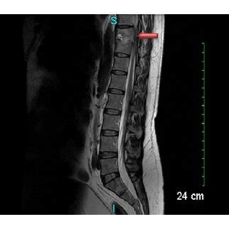 MRI Of Lumbosacral Spine Showing Discitis At T10 T11 Level Red Arrow