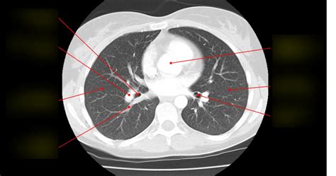 Diagram Of 8 12 Axial CT Lung Window With Contrast Quizlet