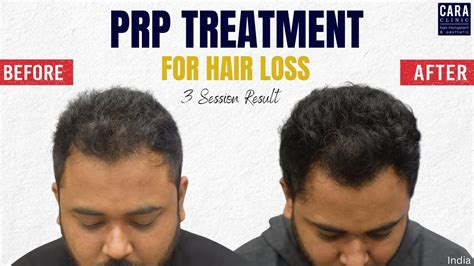 Platelet Rich Plasma Hair Treatment Results Prp Therapy At Cara Youtube