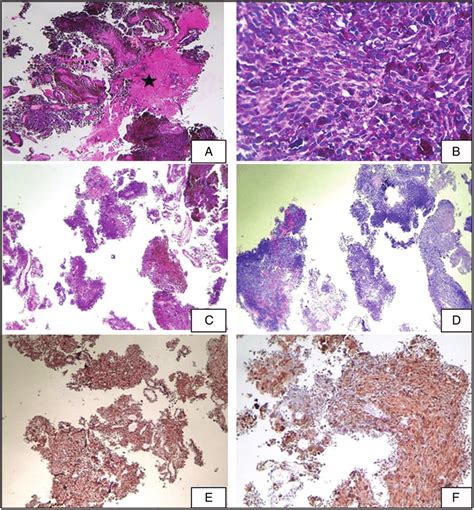 Histopathology Showed Fragments Of Cord Parenchyma Infiltrated By