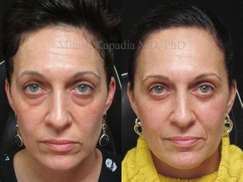 Lower Blepharoplasty Before And After Photos Boston Eyelids