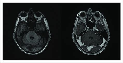 Bilateral Facial Nerve Palsy After Car T Therapy T1 Pre Left And Download Scientific Diagram