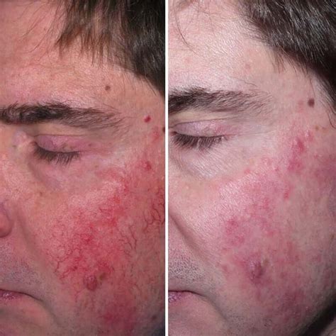 Rosacea Treatment | Before & After | Kingsway Dermatology