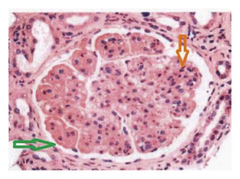 Image A Showing Diffuse Proliferative Glomerulonephritis Reduced