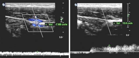 Surgical Management Of Nutcracker Phenomenon Presenting As Left