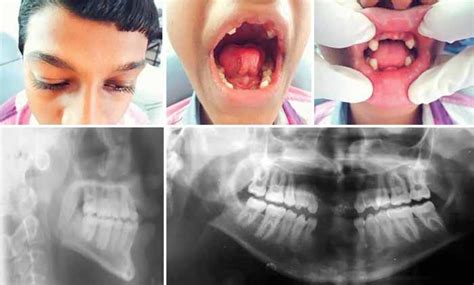 Ellis Van Creveld Syndrome As Related To Bone Abnormalities Pictures