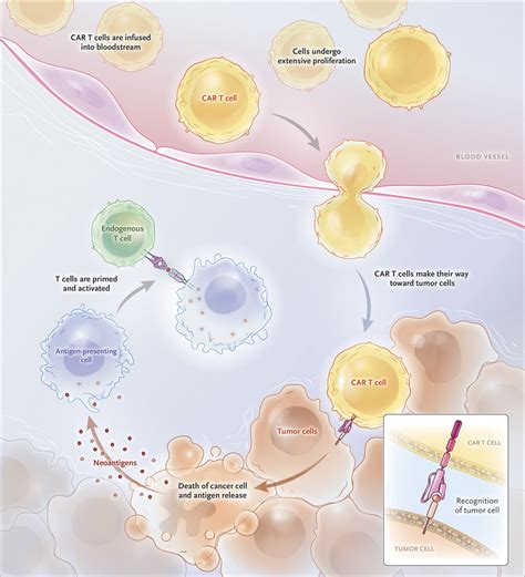 Chimeric Antigen Receptor Therapy Nejm