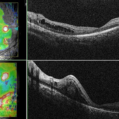 Optical Coherence Tomography Of The Right A And Left B Eyes Showing Download Scientific