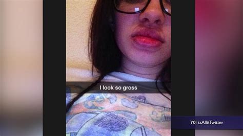 Kylie Jenner Lip Challenge Leaves Terrifying Results