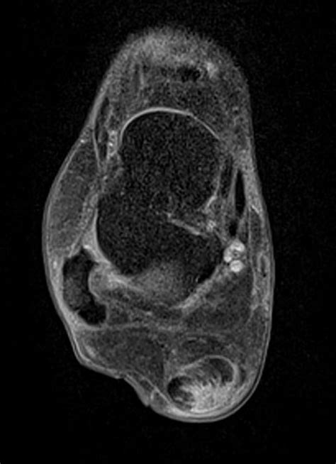 Imagerie Pathologie Arriere Pied Rupture Du Tendon Calcaneen