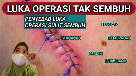 Penyebab Luka Operasi Sembuh Lebih Lama Luka Operasi Tidak Menutup