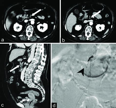 An 87-year-old woman with acute superior mesenteric artery occlusion ...