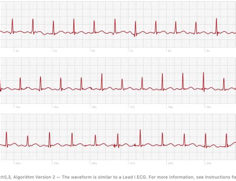 Palpitations caught on Apple ECG. 42/F with palpitations the last month ...