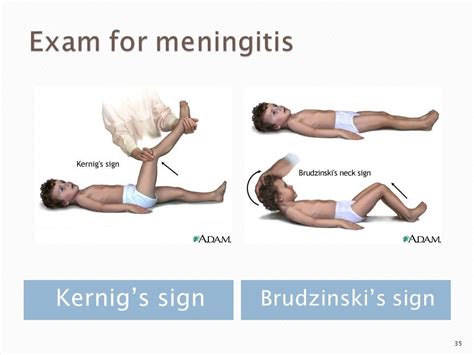 Brudzinski Sign In Meningitis - Other signs of meningitis · sudden high ...