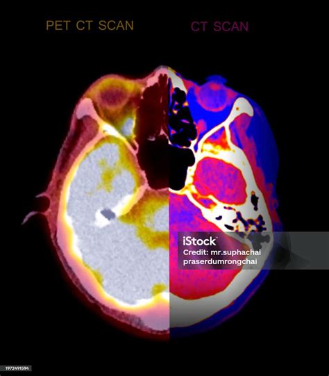 A Petct Scan And Ct Scan Of The Brain Stock Photo - Download Image Now ...