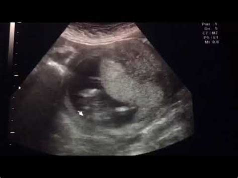 13 Weeks 3 Days Ultrasound Gender Reveal YouTube