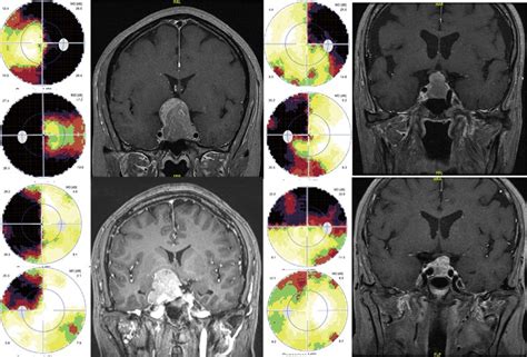 Visual Field And Mri Of Four Patients With Pituitary Adenoma Top Left