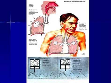 Doença Pulmonar Obstrutiva Crônica Dpoc Ppt