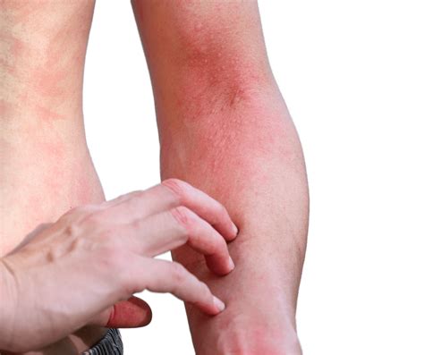 Insect Bites Medical Dermatology Unique Dermatology And Wellness
