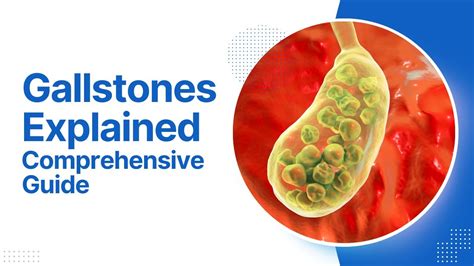 Understanding Gallstones Causes Symptoms And Treatment Comprehensive Guide Youtube