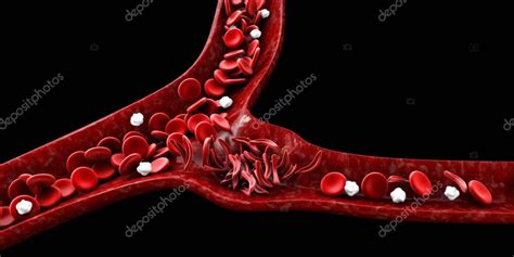 Anemia drepanocítica ilustración 3D que muestra vasos sanguíneos con