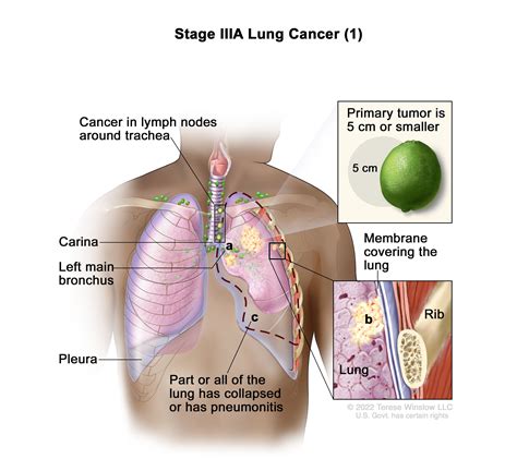 Non-Small Cell Lung Cancer Treatment - NCI