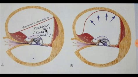 Menieres Disease Part 1 Youtube