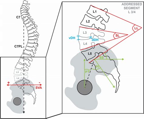 All Evaluated Lumbar Sagittal Alignment Parameters Vdh Ventral Disc