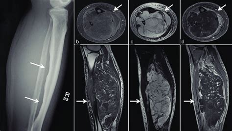 Myxoid Liposarcoma In The Calf Region Lateral Plain Film Of The Right