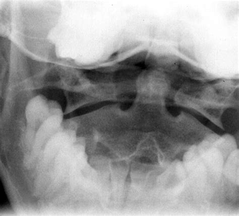 Odontoid Lateral Mass Asymmetry Do We Over Investigate Emergency Medicine Journal